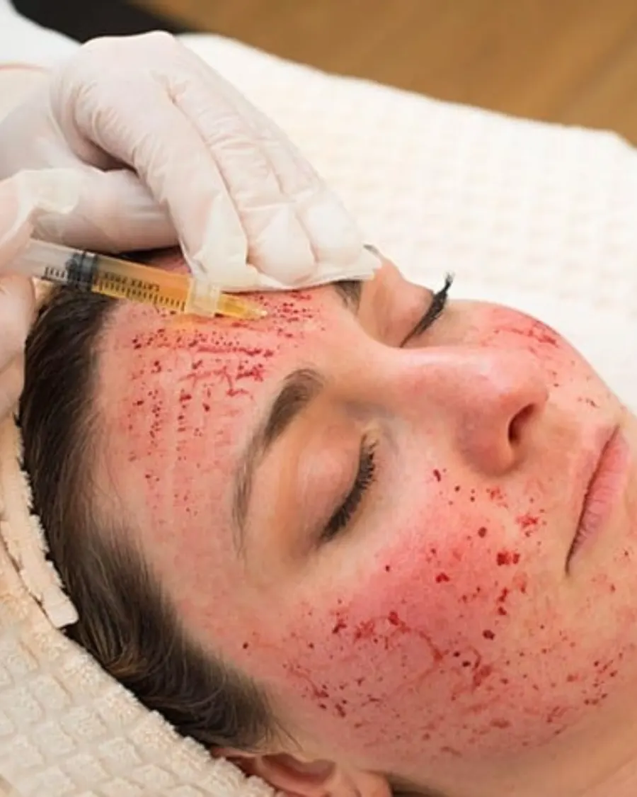 Advanced Skin Regeneration with PRP Therapy at Cinch Clinics